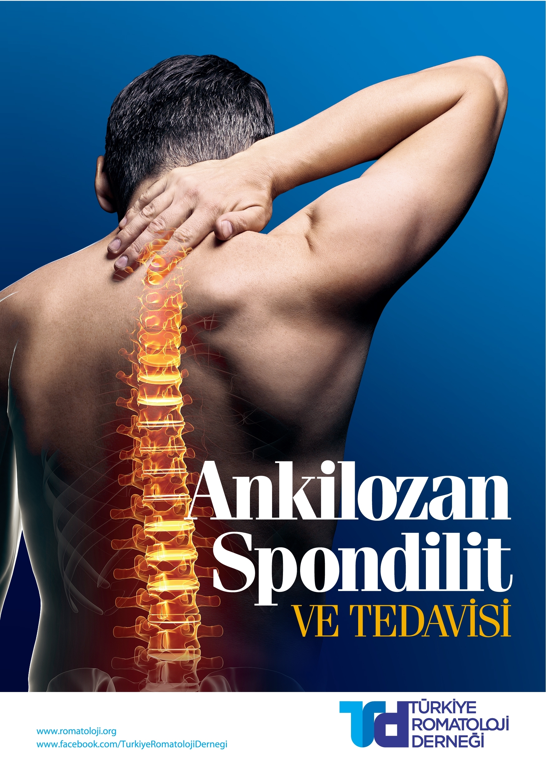 Ankilozan Spondilit ve Tedavisi
