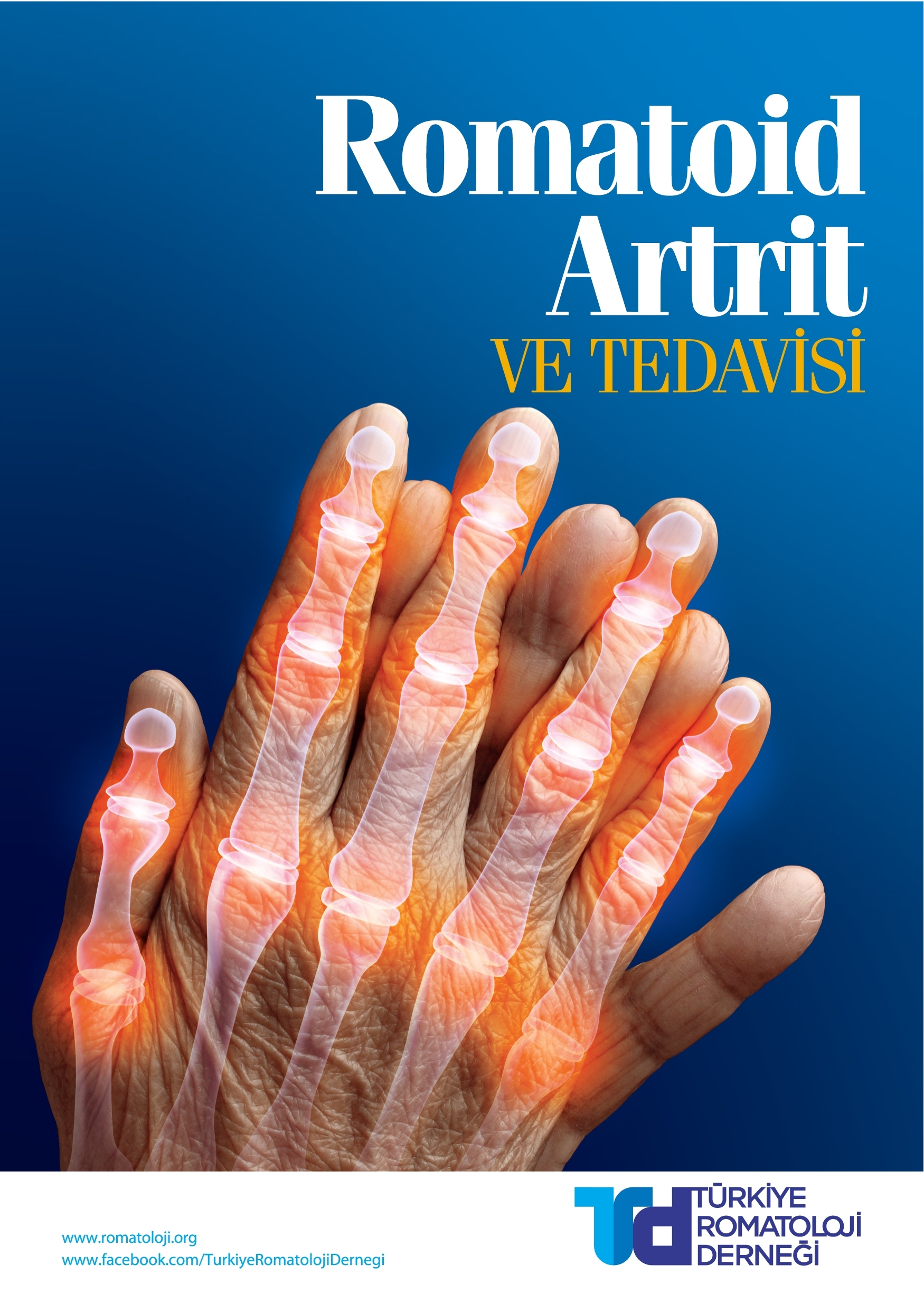 Romatoid Artrit ve Tedavisi