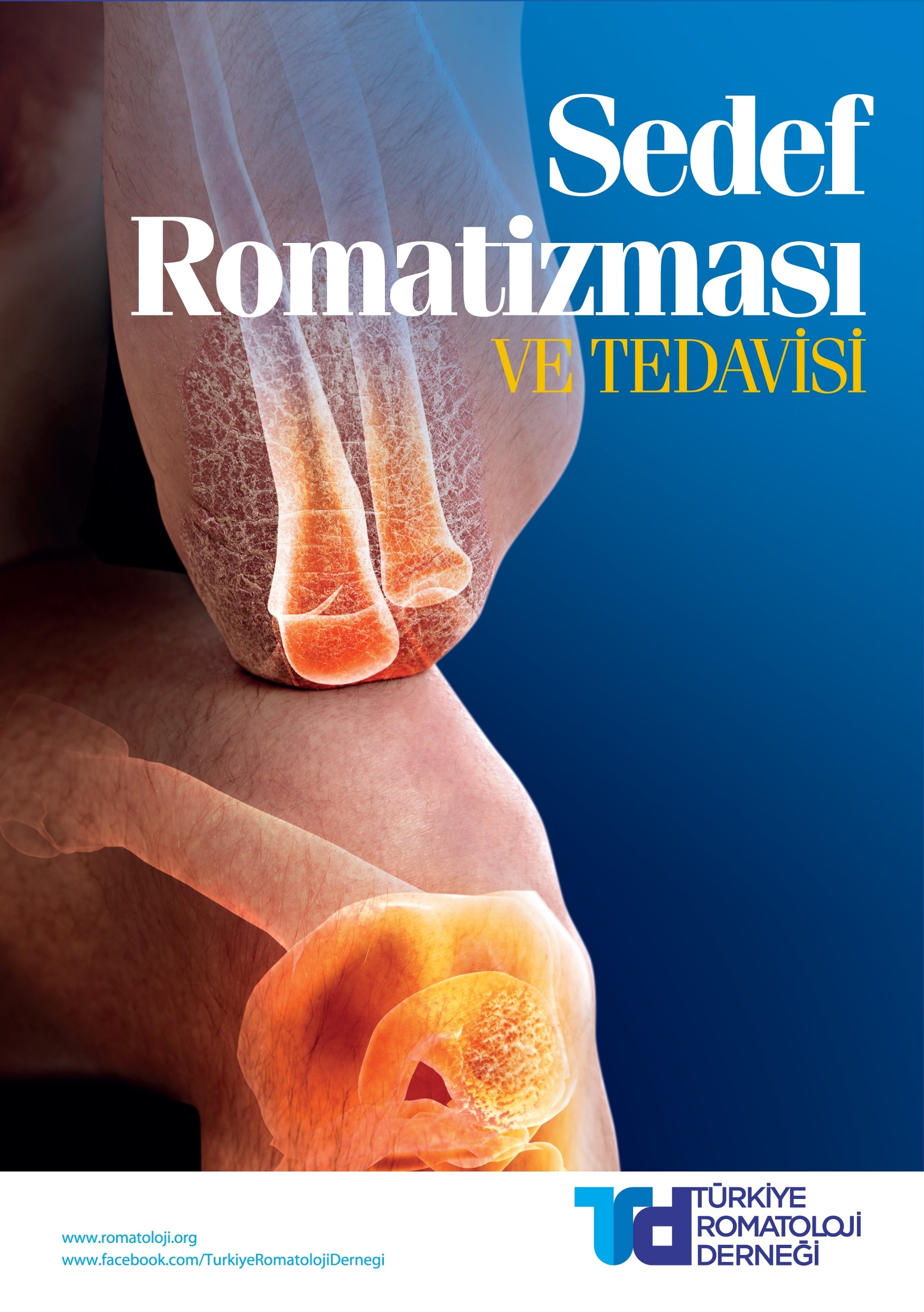 Sedef Romatizması ve Tedavisi